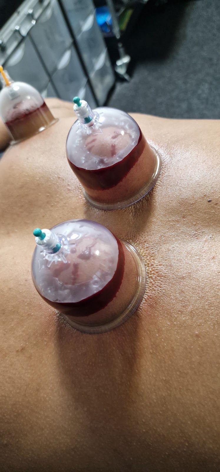Cupping therapy at the Blackburn wellness clinic